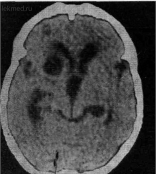 Cysticercoza creierului - tomografie computerizată a creierului