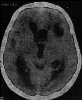 Cysticercoza creierului - tomografie computerizată a creierului