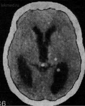 Cysticercoza creierului - tomografie computerizată a creierului