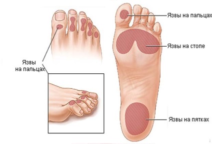 Diabetul gangren - cauze de gangrena la diabet zaharat, site-ul medical