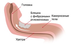 Dr. Vasin - Peyronie betegség