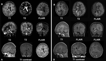 Rasmussen encephalitis - az