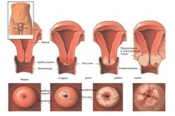 Eroziunea cervicală în tratamentul nulipar