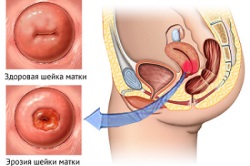 Eroziunea cervicală în tratamentul nulipar