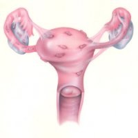 Fitoterapie în tratamentul endometriozei - bisturiu - informație medicală și portal educațional