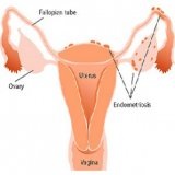 Fitoterapie în tratamentul endometriozei - bisturiu - informație medicală și portal educațional