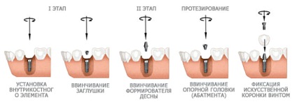 Formator de gumă după implantare ce este și de ce este necesar să o instalați?