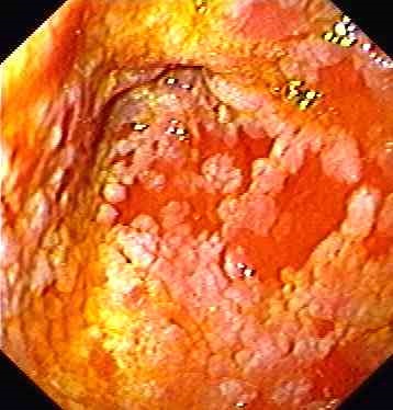 Gastritis cu metaplazie intestinală - cronică și atrofică