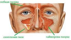 Sinusită simptome, tratament, descriere