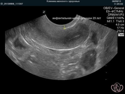 Infantilismul genital