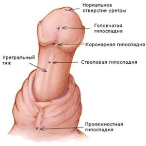 Hypospadias la băieți ce este, hipospadias, tulpină, formă coronariană, operație