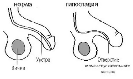 Hypospadias la băieți ce este, hipospadias, tulpină, formă coronariană, operație
