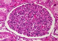 Glomerulonefrita de ultrasunete renale, tratament si diagnostic