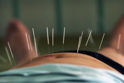 Acupunctura pentru revizuiri de greutate, indicații, contraindicații, rezultate