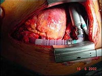 Implantarea unei inimi artificiale