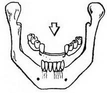Implantul în proteze dentare în stomatologie