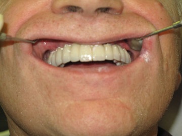 Implantul de dinți în centrul stomatologic dentar sao - universitar