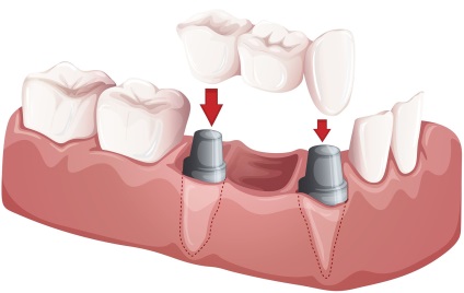 Implantarea dinților în stomatologie - heather - în mare Novgorod - implanturi dentare