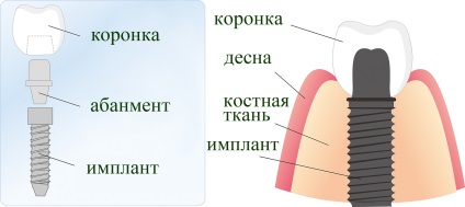 Implantarea dinților în stomatologie - heather - în mare Novgorod - implanturi dentare