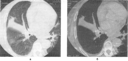 Organisme străine de bronhii, tomografie computerizată