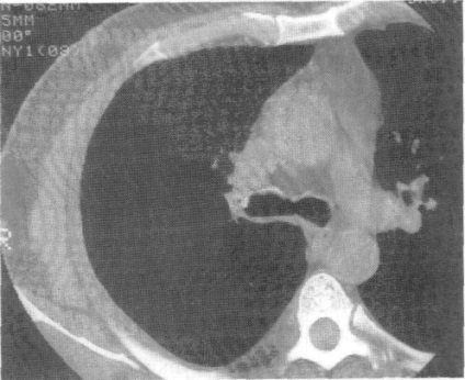 Organisme străine de bronhii, tomografie computerizată