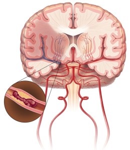 Simptome de accident vascular cerebral ischemic și prim ajutor