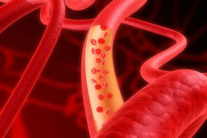 Cum să preveniți apariția contaminării vasculare