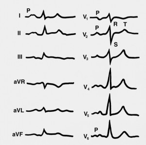 Cum se manifestă hipertrofia ventriculului stâng pe ECG - ce este și cum se diagnostichează