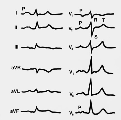 Cum se manifestă hipertrofia ventriculului stâng pe ECG - ce este și cum se diagnostichează