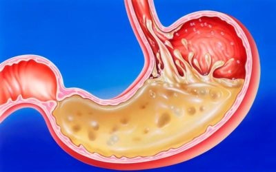 Cum să cunoști aciditatea stomacului la domiciliu