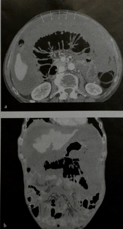 Carcinomatoza peritoneală este cea mai frecventă leziune malignă a peritoneului