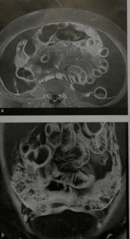 Carcinomatoza peritoneală este cea mai frecventă leziune malignă a peritoneului