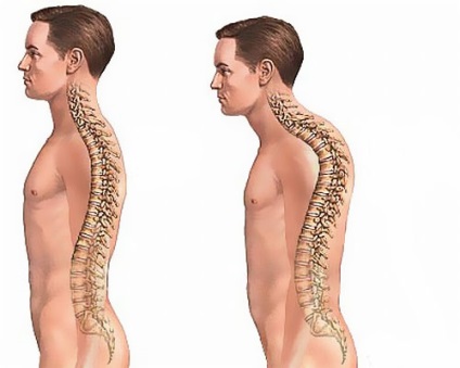 Cifoza coloanei vertebrale tratată cu simptome și grad de dezvoltare