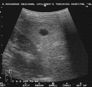 Chistul cavității abdominale a splinei, stomacului, vezicii biliare, intestinelor, simptomelor și tratamentului