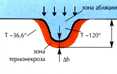 Laser stomatologie