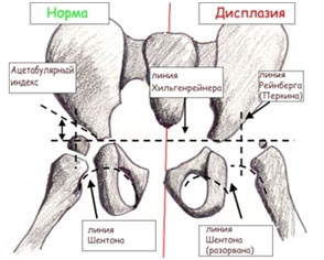 Tratamentul displaziei de șold în cadrul Centrului European de Vertebologie