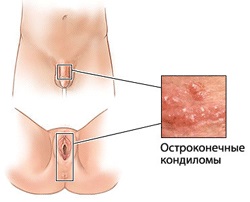Tratamentul verucilor genitale în centrul Moscovei