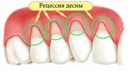 A periodontális betegségek kezelésében lézeres kezelés, vákuum, ultrahang, elektroforézissel