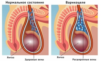 Tratamentul varicocelei fără intervenție chirurgicală