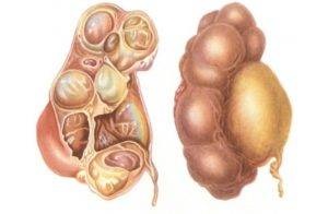 vezikulita otthoni kezelés népi jogorvoslati, hogyan kell kezelni, spermatocystitis