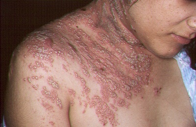 Lichenul înconjoară simptomele și semnele