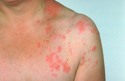 Lichenul înconjoară simptomele și semnele