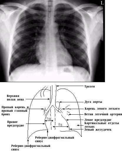 Diagnosticul radiologic al corpurilor străine în tractul respirator - stadopedie