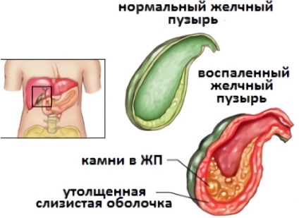 Flatulența în cazurile de pancreatită posibilă și tratamentul necesar