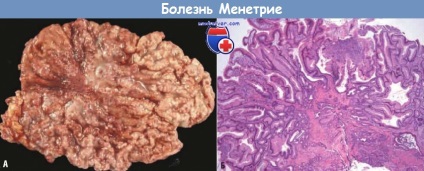 Mecanismul dezvoltării (patogenezei) menetriei bolii