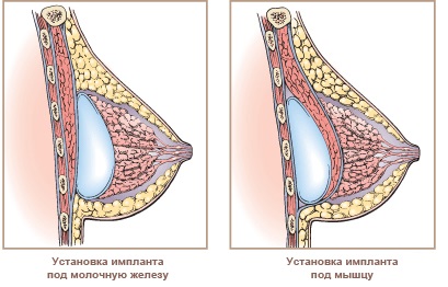 Mituri despre plasticile mamare și implanturile