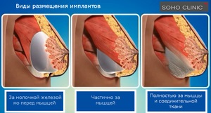 Mituri despre plasticile mamare și implanturile