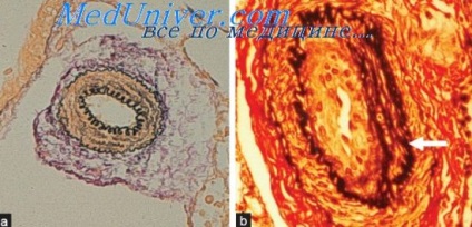 Diureticele în insuficiența cardiacă - tratament cardiac