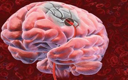 Brain hemoragie la nou-nascuti consecinte si cauze