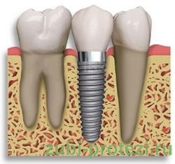 Este posibil să sudați o punte dentară